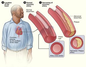 Coronary Artery Disease Management - Chatham Heart CenterChatham Heart ...